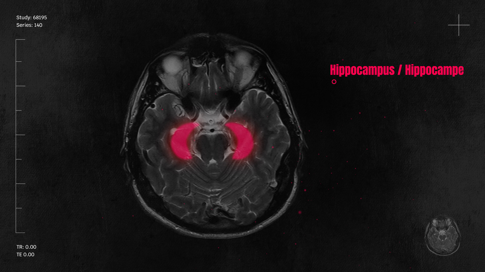Heilende Drogen / Les psychédéliques, des drogues qui soignent ? ARTE TV Haupttitel, Bauchbinden, Erklärgrafiken – example image of the animation | MARIA LISSEL Animation + Motion Design | maria-lissel.de